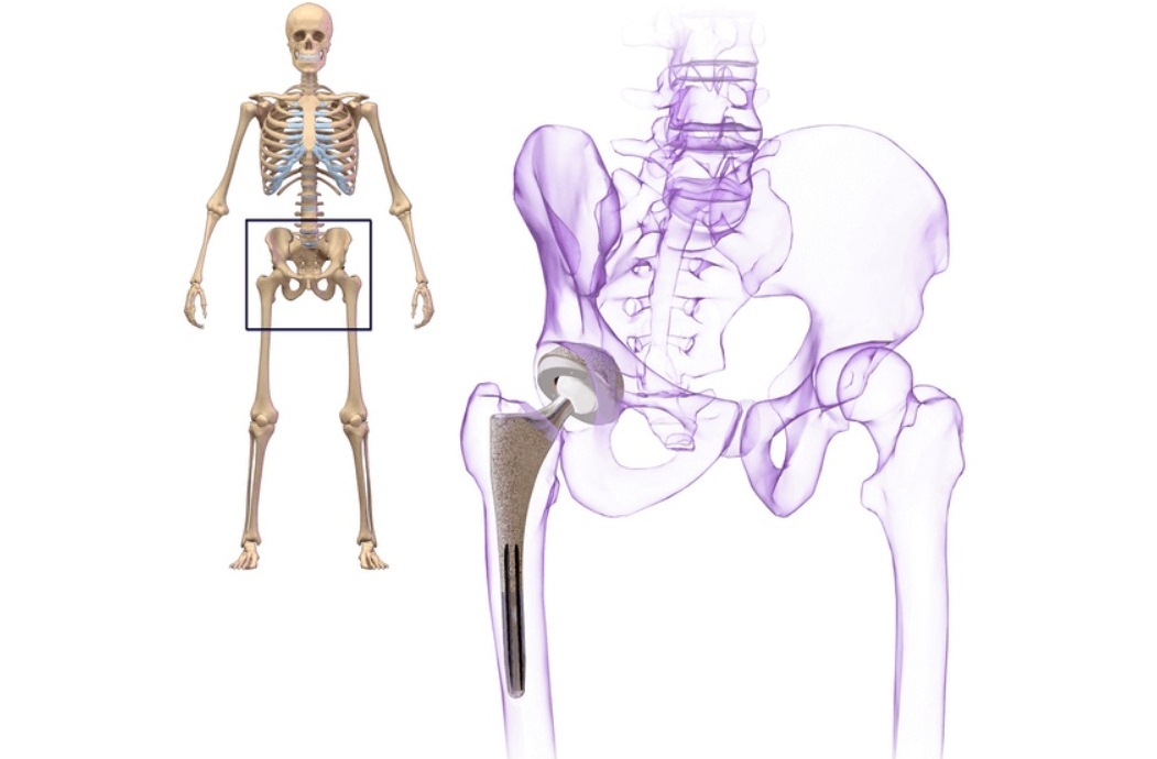 Тазобедренная кость. Имплант бедренной кости. Бедренная кость имплантат. Тазобедренный сустав немецкий. Германский имплант тазобедренного сустава.